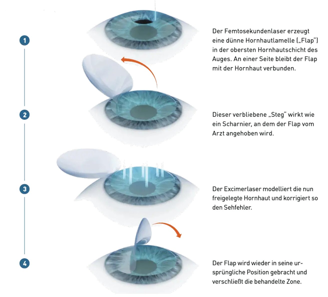 Ablauf SmartSurfACE Schritt für Schritt